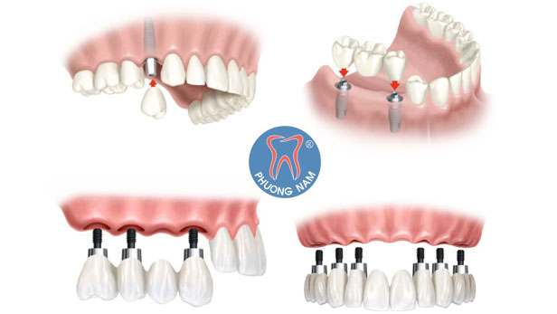 Một số trường hợp áp dụng công nghệ trồng răng Implant