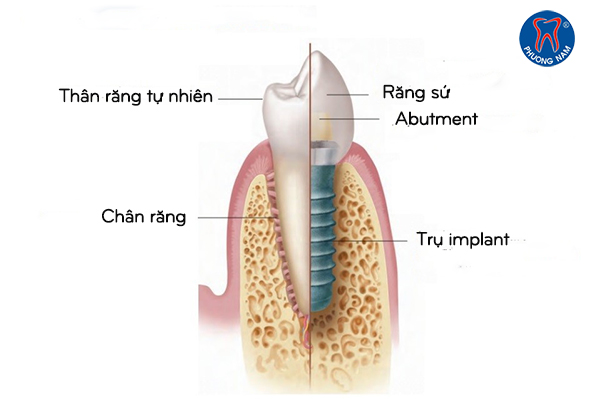 Mô phỏng cấu tạo của chiếc răng được hoàn thiện bởi công nghệ Implant-1