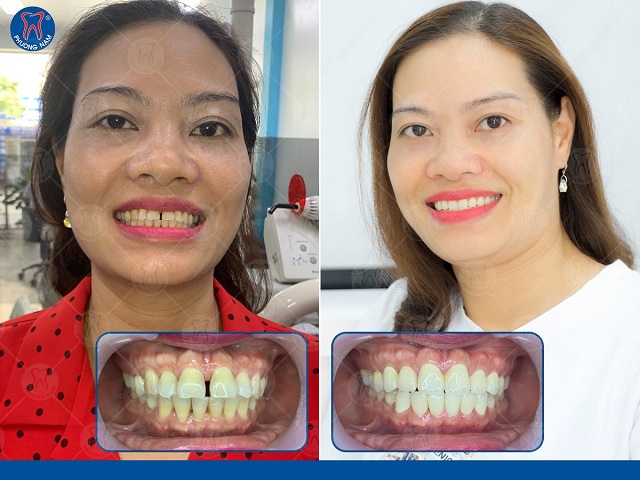 Bọc răng sứ bảo tồn răng thật tối đa - 1