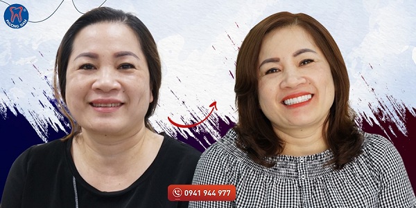 Dán sứ là phương pháp khiến bạn trẻ ra vài tuổi tự tin với nụ cười - 1