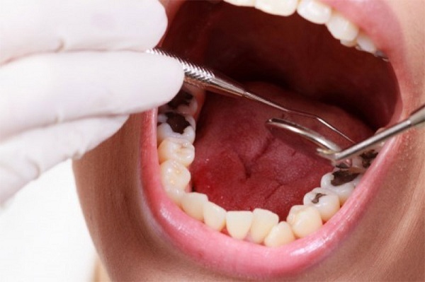 Hàn trám răng giúp khắc phục tình trạng răng sâu hiệu quả - 1