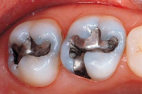 Phương pháp hàn trám răng amalgam thường sử dụng cho răng hàm - 1