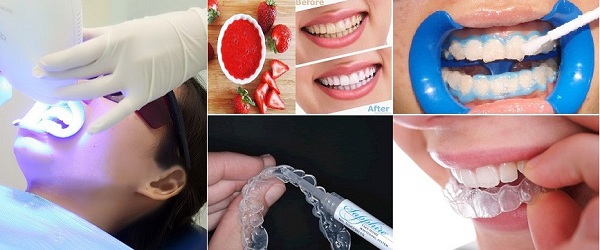 Phương pháp tẩy trắng răng tại nhà và phòng khám có ưu và nhược điểm riêng biệt - 1