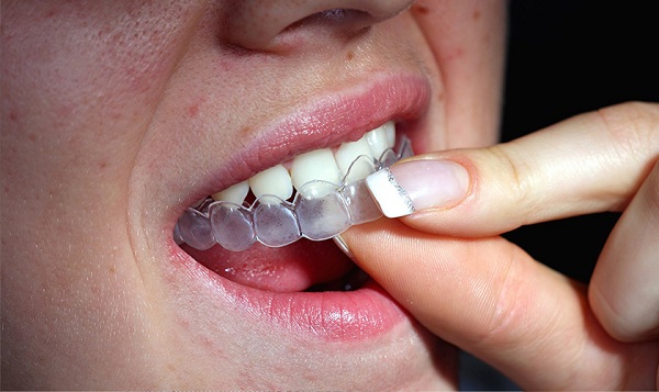 Tẩy trắng răng tại nhà đơn giản dễ thực hiện - 1