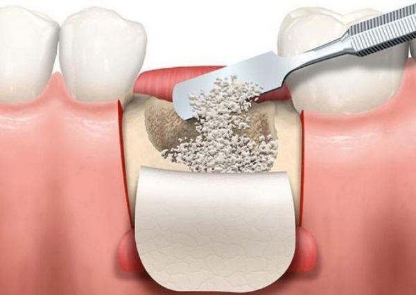 trồng răng implant 3