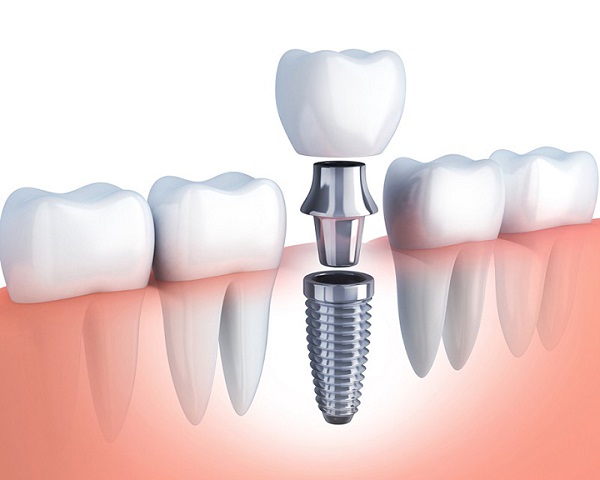 trồng răng implant 4