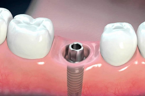 trồng răng implant 5