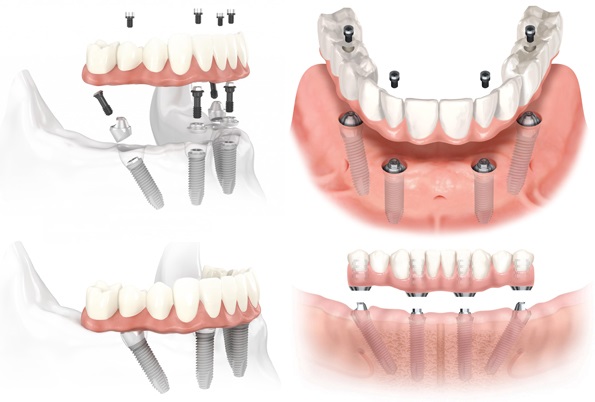 trồng răng implant 7