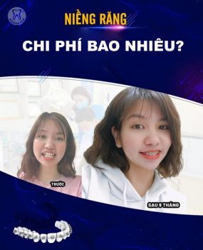 Niềng răng chi phí bao nhiêu? - 1
