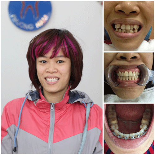 Khách hàng niềng răng tại nha khoa Phương Nam 