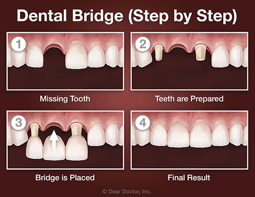 Các phương pháp trồng răng được chuyên gia khuyên dùng 3