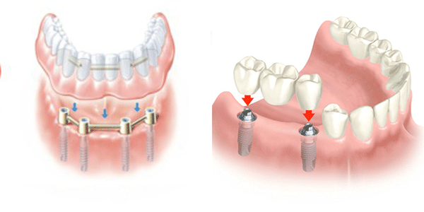 Các phương pháp trồng răng được chuyên gia khuyên dùng 5