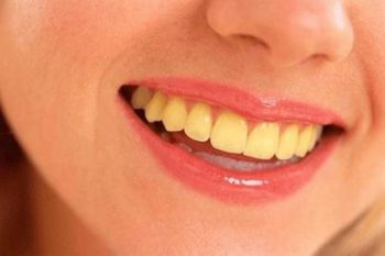 Nguyên nhân gây ra tình trạng ố vàng răng và cách cải thiện hiệu quả