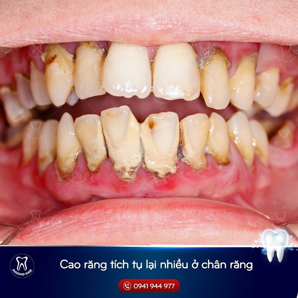 Hàm răng bị viêm nha chu thường do nhiều cao răng mảng bám - 1