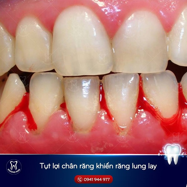 Viêm nha chu sẽ gây hiện tượng chảy máu chân răng và tụt lợi 