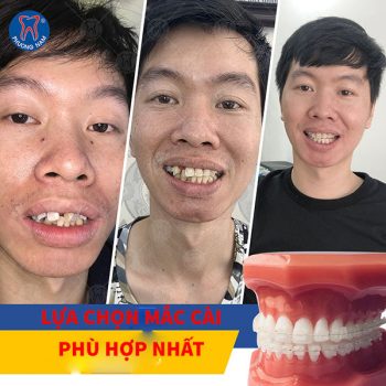 Lựa chon loại mắc cài phù hợp nhất với bạn -