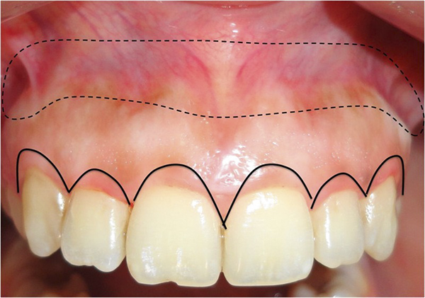Thân răng ngắn sẽ được kéo dài hơn nhờ vào thủ thuật tiếu phẫu đơn giản -1