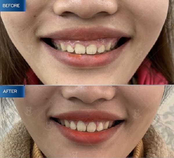 Niềng răng cũng là phương pháp cải thiện nụ cười hở lợi - 1