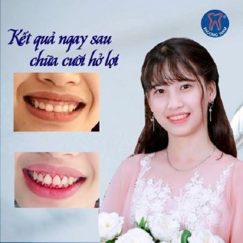 Xinh đẹp rạng ngời sau khi chữa cười hở lợi tại Nha khoa Phương Nam - 1