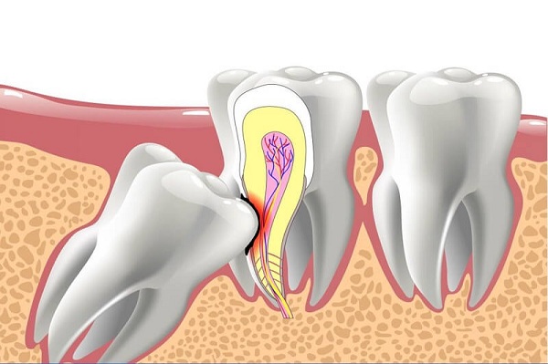 Răng khôn gây đau đớn cần loại bỏ sớm - 1