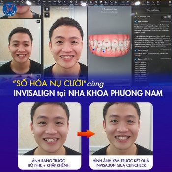 Phần mềm Clincheck với công nghệ invisalign là một bộ đôi hoàn hảo - 1