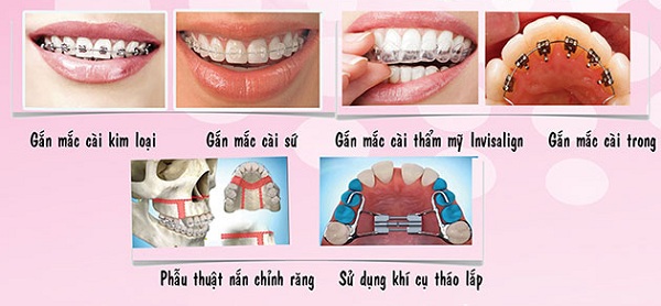 Các loại mắc cài thường được lựa chọn trong niềng răng -1