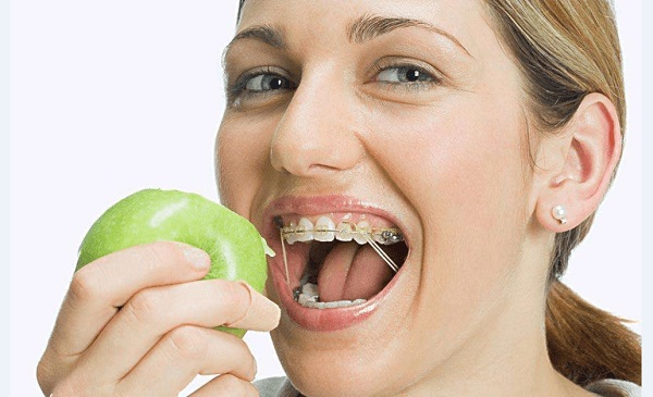 Bạn cũng cần chú ý đến quá trình ăn uống chăm sóc trong khi niềng răng -1