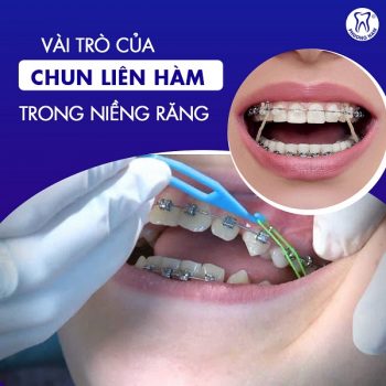 Vai trò của chun liên hàm trong niềng răng là gì?