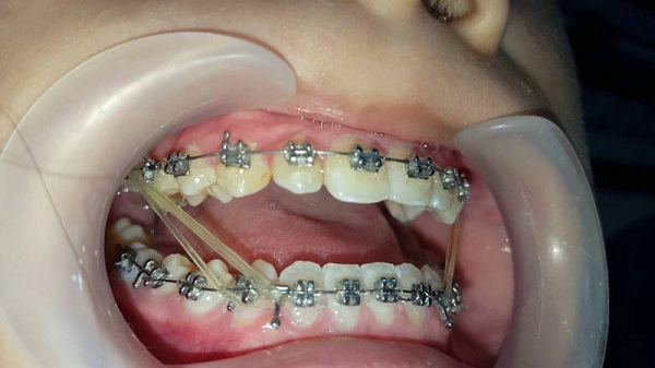 Chun liên hàm đóng vai trò trong việc kéo nắn chỉnh răng về vị trí đều đẹp -1