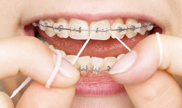 Đeo chun liên hàm đúng cách để có 1 hàm răng đẹp -1