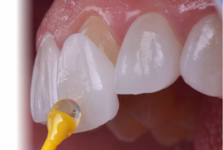 Các lưu ý hạn chế nhược điểm của dán răng sứ veneer