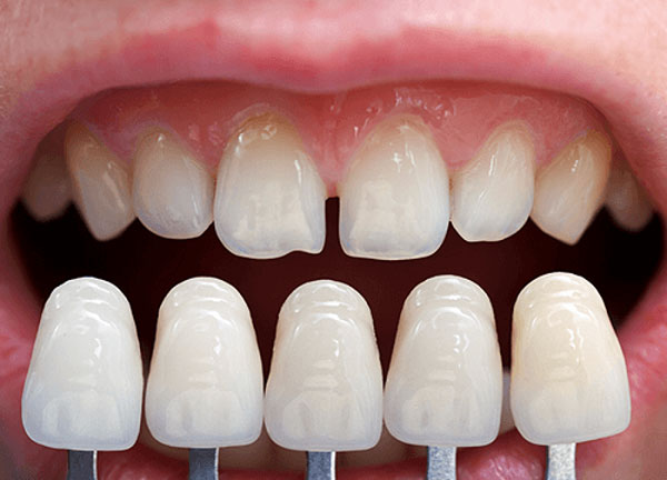 Các vấn đề xảy ra từ nhược điểm của bọc răng sứ