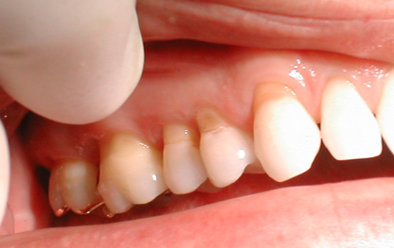 Dấu hiệu răng sứ bị hở có ảnh hưởng gì không