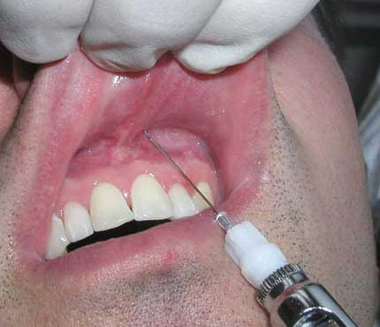 Gây tê vùng cần điều trị, mài cùi răng và kiểm tra khớp cắn