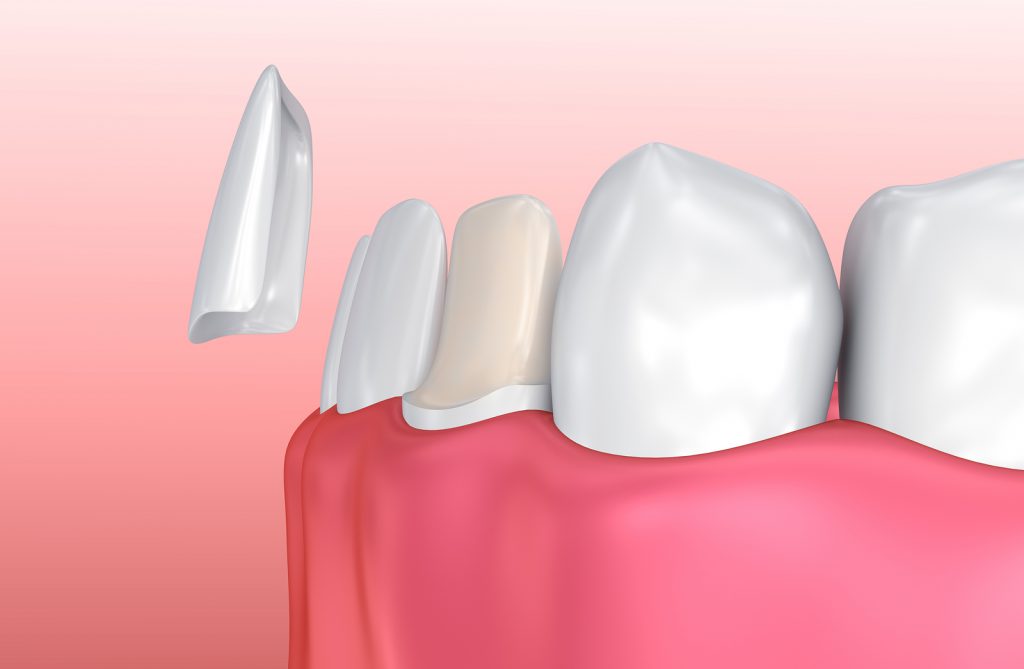 Phương pháp dán răng sứ