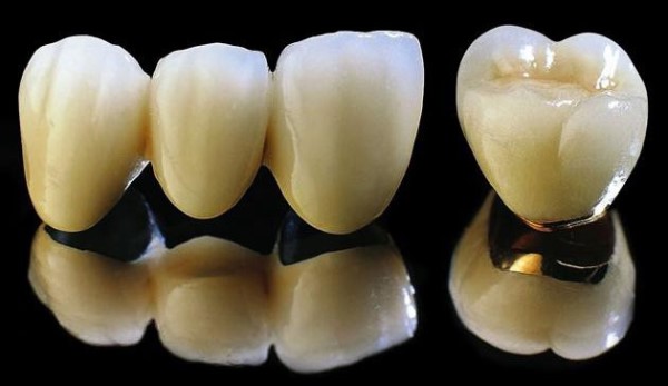 Răng sứ kim loại thường