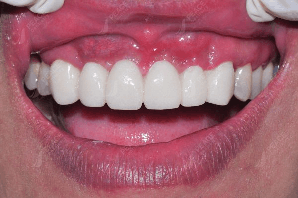 Tại sao có tình trạng cầu răng sứ bị hở?