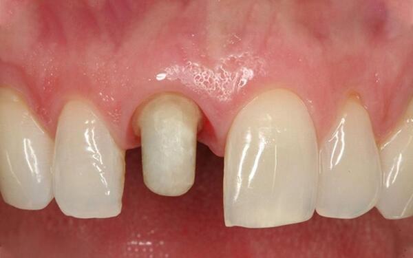 Viêm tủy răng khi làm răng sứ