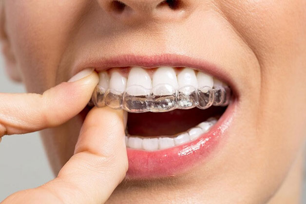 Cơ chế hoạt động của niềng răng trong suốt