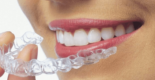Có thể rút ngắn thời gian niềng răng trong suốt hay không