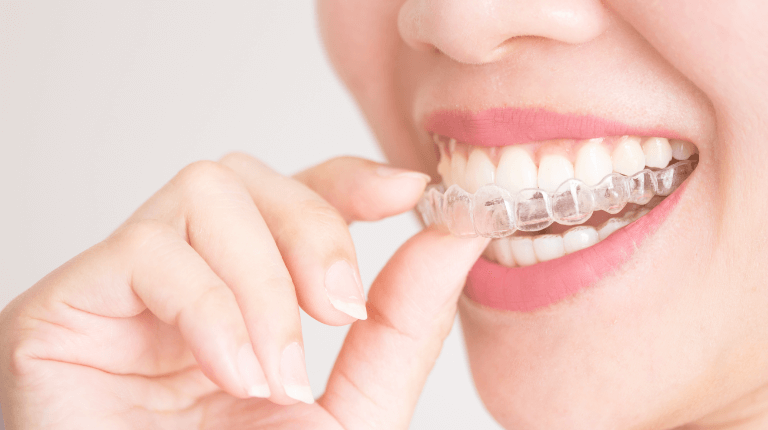 4 phương pháp niềng răng thưa hiệu quả bạn cần biết 
