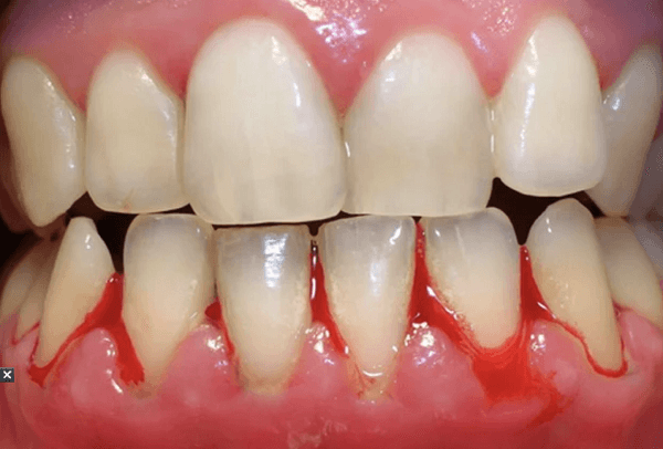 Bọc răng sứ bị chảy máu thì phải làm sao để khắc phục?