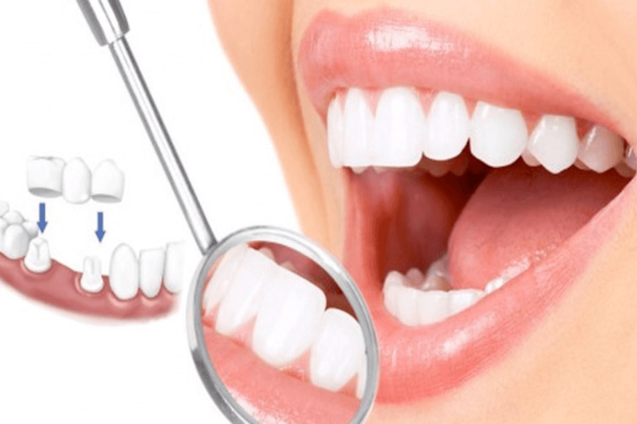 Bọc răng sứ bị cộm do lấy dấu răng không đúng cách