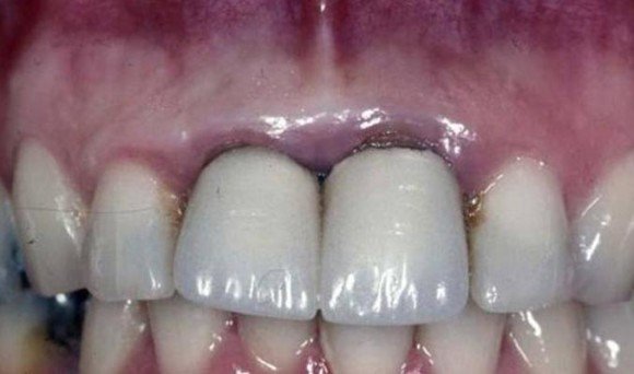 Bọc răng sứ bị đen nướu khắc phục như thế nào?