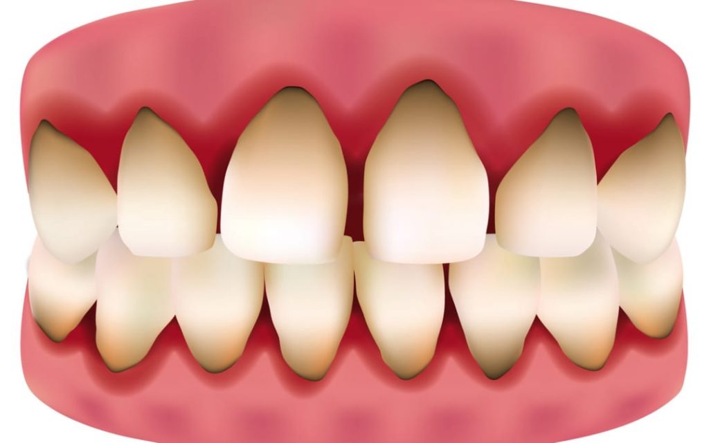 Cách khắc phục bọc răng sứ bị đen nướu hiệu quả