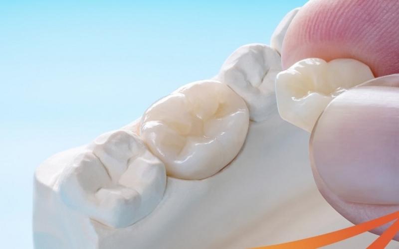 Cách khắc phục tình trạng bọc răng sứ bị lệch khớp cắn