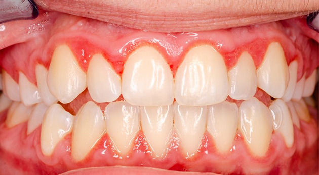 Cách khắc phục tình trạng răng bọc sứ bị viêm tuỷ