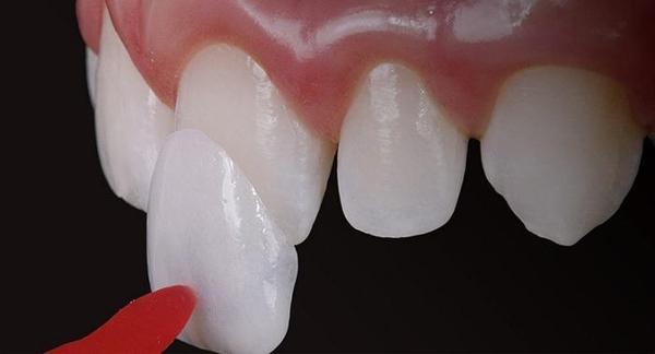 Dán răng sứ có bền không?