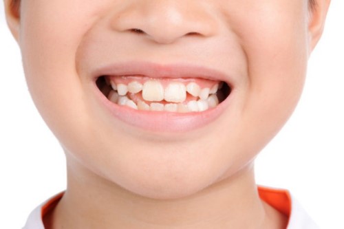 Độ tuổi bọc răng sứ phù hợp nhất là lúc nào?