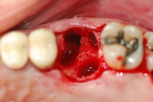 Một số biến chứng khó lường sau khi nhổ răng số 8 